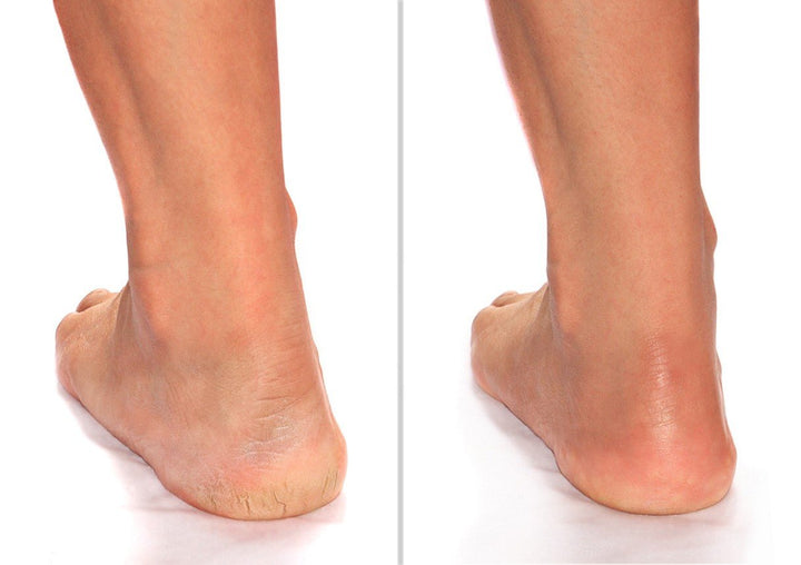 Advanced Clinicals Cracked Heel Rough Spot Cream 8 Fl Oz - Pure Valley 