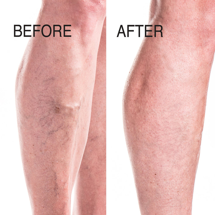 Advanced Clinicals Vein Cream Varicose Vein Cream 8 Fl Oz - Pure Valley 