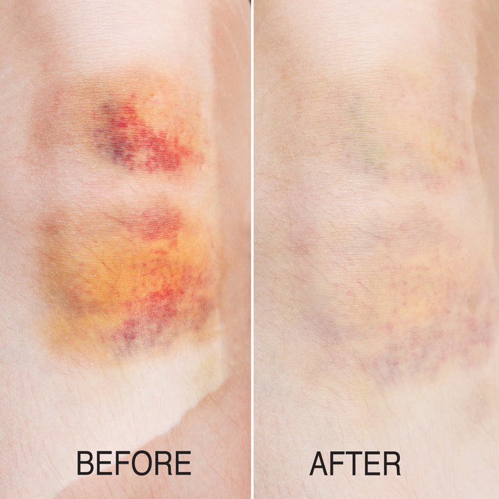 Pure Relief Arnica Bruise Treatment Cream 4 Fl Oz - Pure Valley 